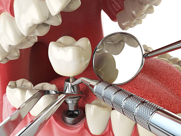 Best Chipped Tooth Repair Near Me  in Dimmitt, TX